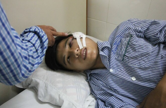 Tuần tra đêm, cảnh sát cơ động bị ném đá vỡ xương mặt