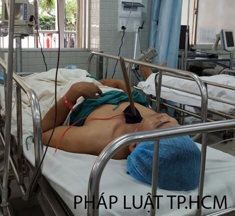 Cấp cứu một dân phòng bị kẻ trộm chó bắn tên trúng ngực 