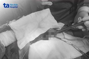 Phát hiện gạc y tế bị bỏ quên gần 10 năm trong bụng bệnh nhân
