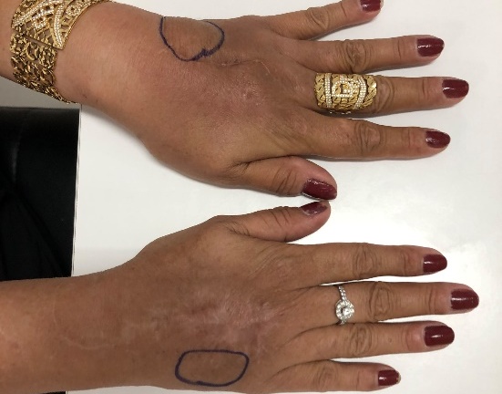 Bơm silicon để tạo tay búp măng, người phụ nữ nhận cái kết đau đớn sau 20 năm