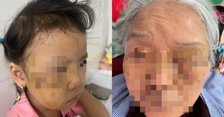 Lại gần khi xem chó nhà ăn, bé gái bị cắn tổn thương vùng mặt