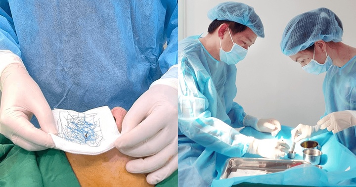 Người đàn ông bị nhiễm trùng mũi nghiêm trọng sau thủ thuật thẩm mỹ