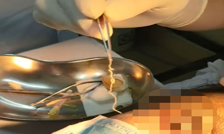 Kinh hãi phát hiện giun dài 10cm ngoe nguẩy trong mắt người phụ nữ