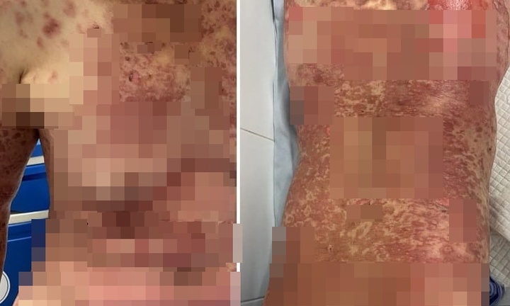 Bác sĩ cảnh báo nguy cơ dị ứng thuốc nặng sau điều trị bằng thuốc nam