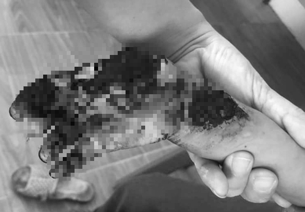 Lào Cai: Cầm vào đầu dây sạc điện thoại, cháu bé 3 tuổi bị giật cháy tay