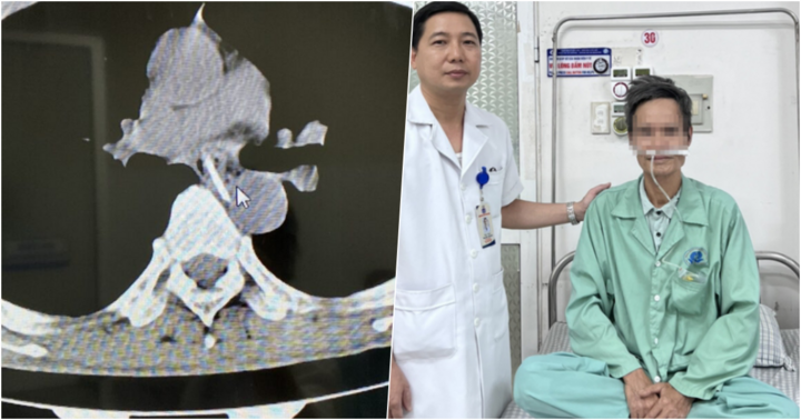 Phú Thọ: Đang ăn thịt gà, người đàn ông phải suýt mất mạng vì nguyên nhân ít ai ngờ tới