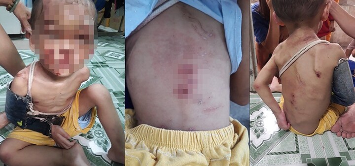 Vụ bé trai 2 tuổi nhập viện do có nhiều vết thương: Mẹ ruột thừa nhận đánh con