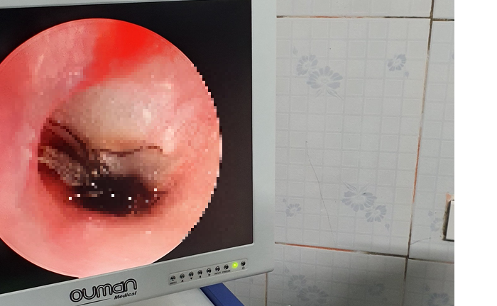 Một con gián được phát hiện còn sống trong tai bé trai 2 tuổi