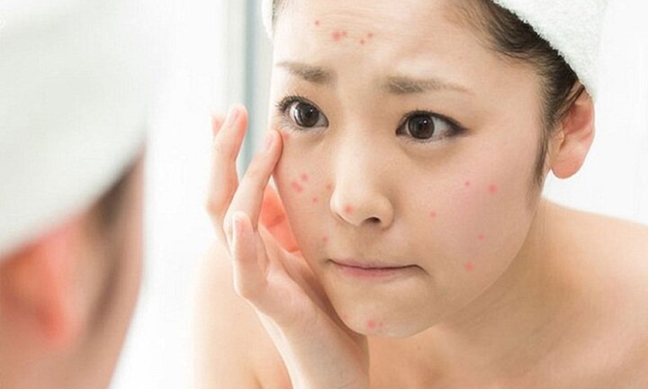 Các thành phần gây mụn có trong mỹ phẩm chị em cần tránh