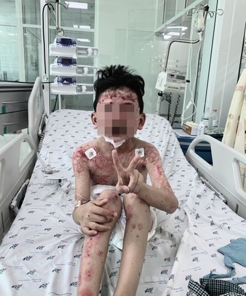 Bệnh nhi mắc triệu chứng hiếm gặp sau khi ăn cua 2 ngày