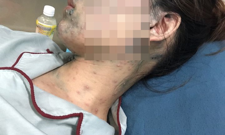 Bệnh nhân mang thai 22 tuần phải nhập viện do mắc thủy đậu bội nhiễm