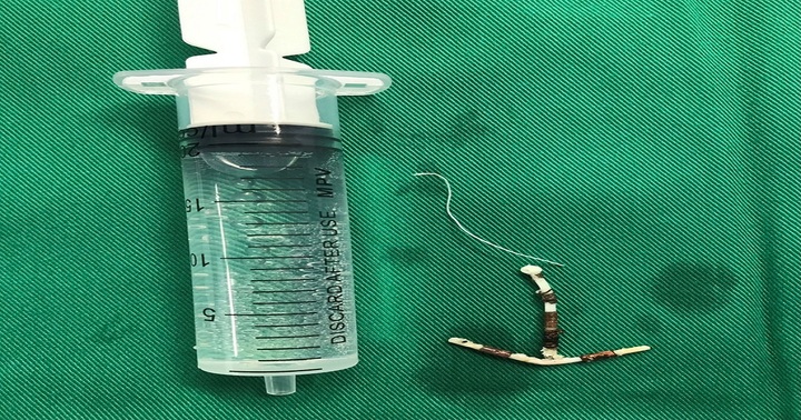 Phát hiện vòng tránh thai trong bàng quang người phụ nữ