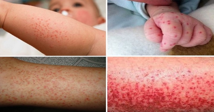 Cách phòng tránh bệnh sốt xuất huyết tại nhà 