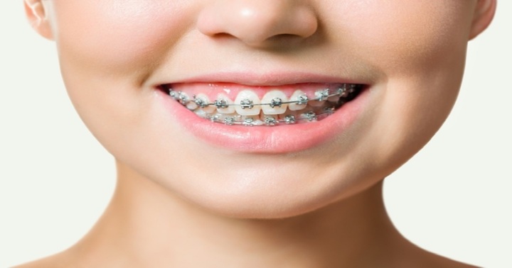 Bật mí mẹo nhỏ giúp người niềng răng ăn không tuột mắc cài