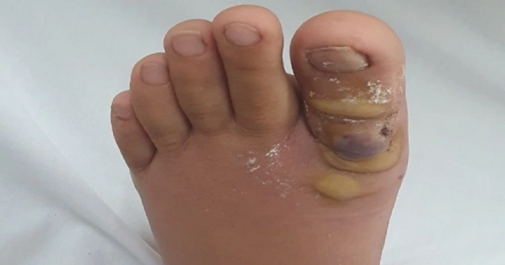 Hy hữu: Thiếu nữ 19 tuổi phải nhập viện sau khi nhổ sợi lông mọc ngược