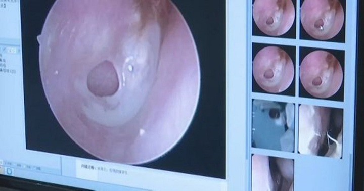 Cô gái bị bạn trai hôn cuồng nhiệt đến mức thủng màng nhĩ