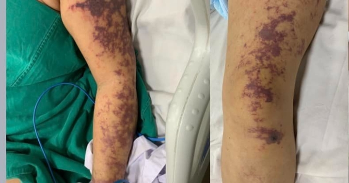 Hà Nội: Người phụ nữ bị sốc nhiễm khuẩn, suy hô hấp sau khi ăn lòng lợn