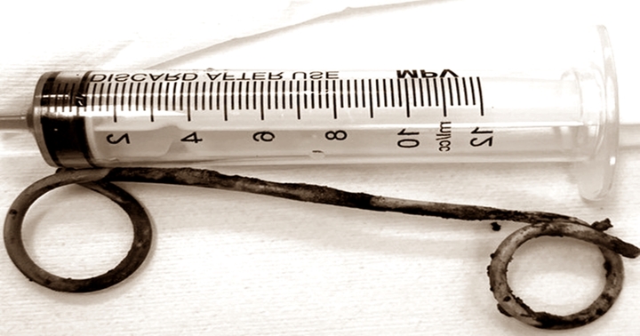 Cảm thấy đau bụng âm ỉ cụ bà đi khám thì phát hiện stent nhựa dài 15 cm bị bỏ quên trong ống mật