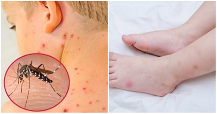 Có thể bạn chưa biết những yếu tố này sẽ khiến bệnh sốt xuất huyết trở nặng hơn