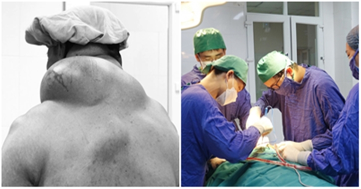 Phẫu thuật thành công khối u mỡ “khủng” nặng 1,5kg cho người đàn ông 50 tuổi