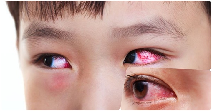 Hải Dương: Ghi nhận 106 chùm ca bệnh đau mắt đỏ tại các trường học