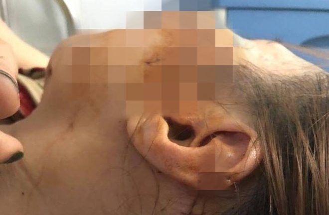 Vụ chồng xông vào xưởng may, rạch mặt vợ ở Thanh Hóa: Kết quả giám định thương tích