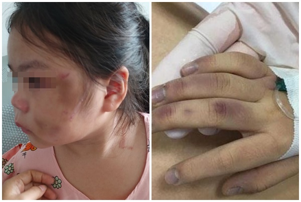 Bé gái bầm tím mặt vì bố 