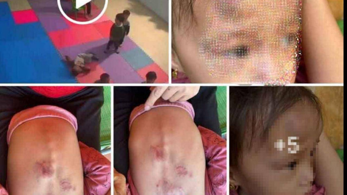 Vụ bé 22 tháng tuổi bị bạn đánh, cắn bầm tím người tại lớp: Tạm đình chỉ cơ sở mầm non