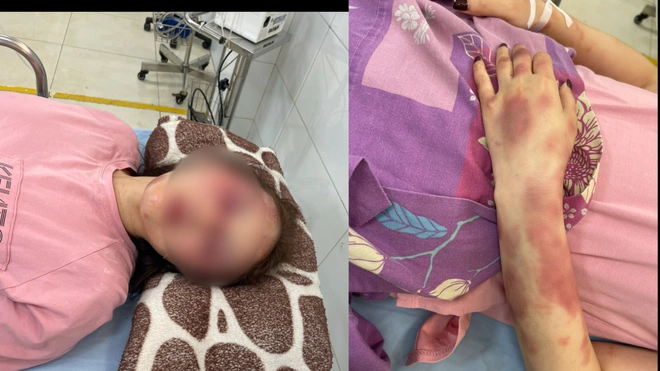 Em gái nạn nhân bị đánh do song ca ở quán karaoke: Nhìn thấy chị, tôi rất sốc và hoảng sợ