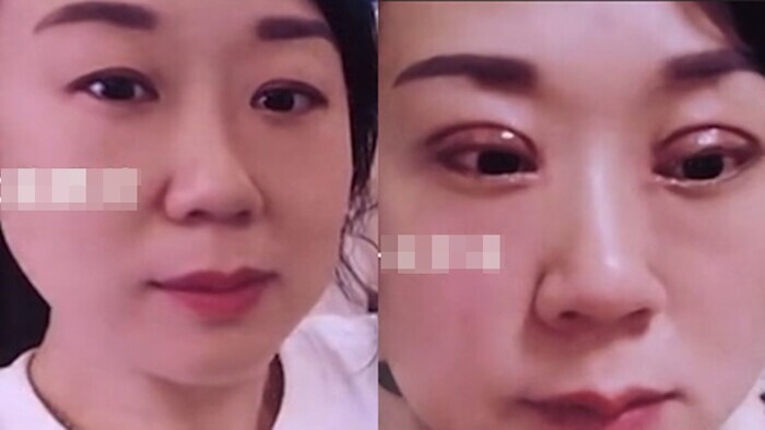 Chi hơn 72 triệu phẫu thuật cắt mắt 2 mí nhưng thất bại, vợ đau đớn bị chồng đâm đơn ly hôn
