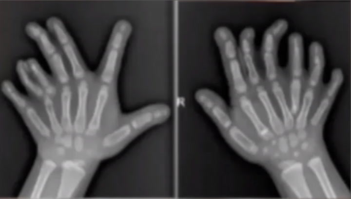 Tin tức đời sống ngày 17/6: Ngỡ ngàng bé 4 tuổi có đến 14 ngón tay, 13 ngón chân