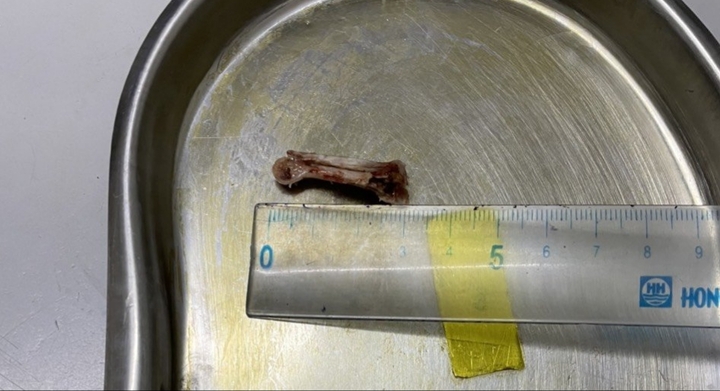 Tin tức đời sống ngày 25/6: Cấp cứu thành công người đàn ông sơ ý hóc xương vịt