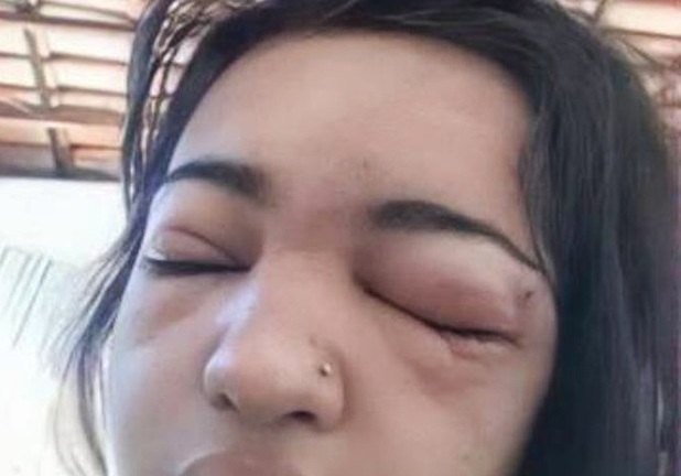 Thiếu nữ 15 tuổi qua đời đau đớn chỉ vì xỏ khuyên làm đẹp, bác sĩ cảnh báo điều quan trọng