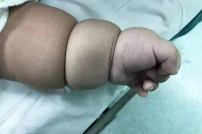 Con trai bụ bẫm, tay chân chia khúc như củ sen, mẹ chưa kip vui đã suýt ngất vì câu nói của bác sĩ