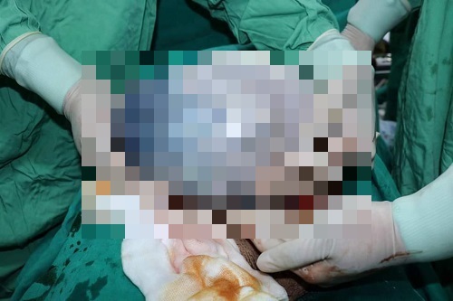 Tin tức đời sống ngày 1/8: Ngỡ ngàng sản phụ sinh đôi, một bé còn trong bọc ối