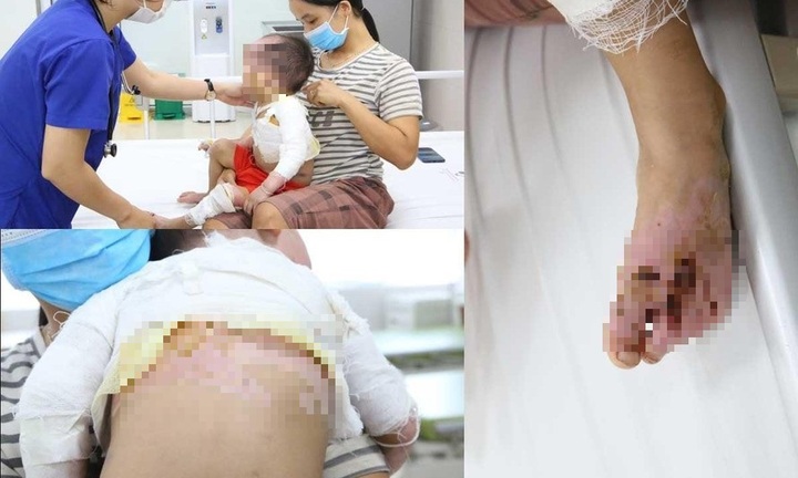 Tin tức đời sống ngày 19/8: Bị cả nồi chè đỗ đen nóng đổ vào người, bé 2 tuổi bỏng nặng