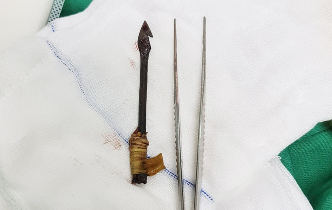 Tin tức đời sống ngày 9/9: Bé trai 8 tuổi bị mũi tên đâm xuyên nhãn cầu vào nền sọ