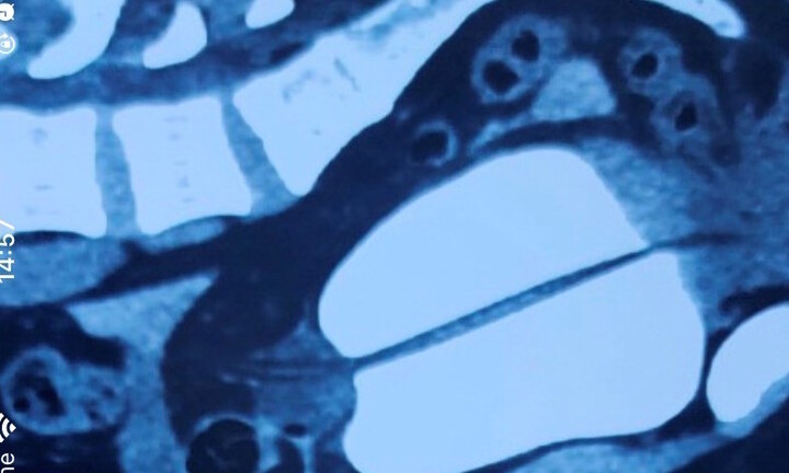 Tin tức đời sống ngày 22/12: Thanh niên vỡ bàng quang sau một “trận bia” cùng bạn bè