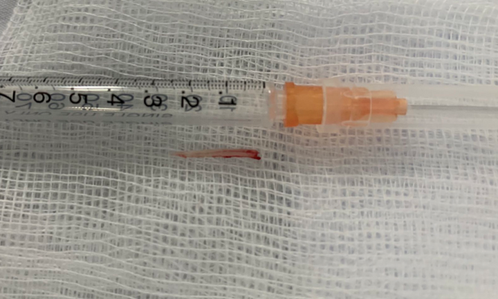 Tin tức đời sống ngày 12/1: Bé 3 tuổi suýt chết vì mảnh xương cá đâm trúng vị trí hiểm