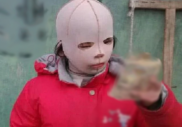 Cô bé 10 tuổi trùm mặt nạ kín mít khi đi học, lúc gỡ ra ai nấy “khóc như mưa”