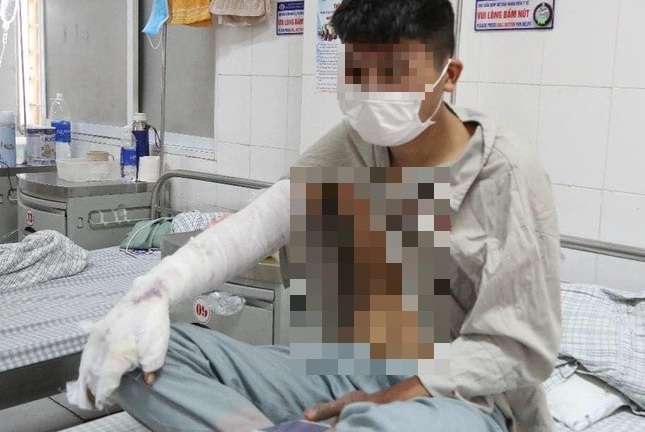 Tin tức đời sống ngày 9/2: Thanh niên bỏng nặng vì bình ga mini phát nổ khi ăn lẩu