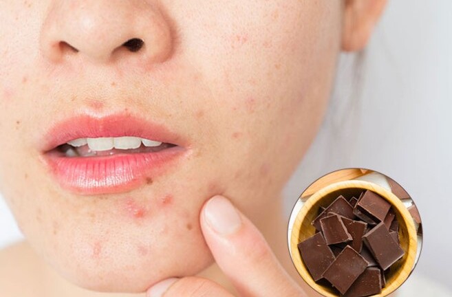 Socola gây hại ra sao khi ăn quá nhiều?