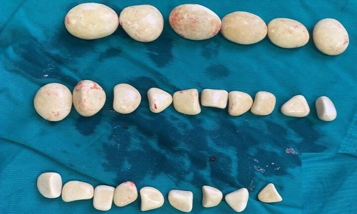 Tin tức đời sống ngày 22/4: Người đàn ông có hàng chục viên sỏi trong bàng quang