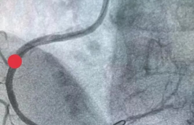 Tin tức đời sống ngày 24/4: Cụ bà 97 tuổi bị nhồi máu cơ tim cấp