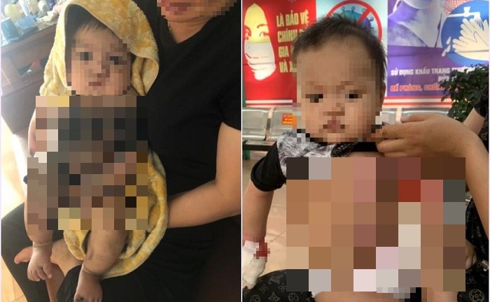 Bé 6 tháng tuổi bị nhiễm trùng vì gia đình đắp thuốc nam chữa bỏng