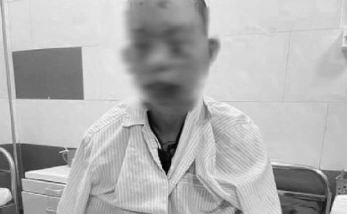 Mất thị lực, cháy sém toàn thân vì sử dụng điện thoại khi đang sạc