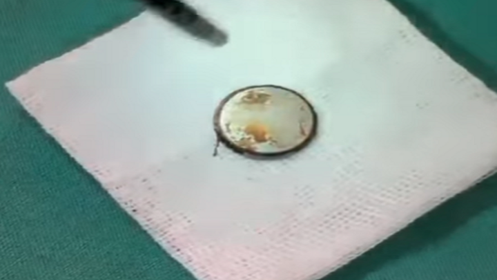 Tin tức đời sống ngày 3/5: Viên pin nằm trong thực quản bé 3 tuổi gần 1 tuần