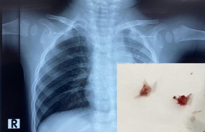 Tin tức đời sống ngày 14/5: Bé trai 1 tuổi ho sặc sụa, tím tái khi đang ăn cháo lươn
