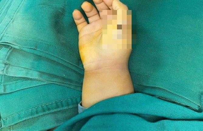 Tin tức đời sống ngày 21/5: Phẫu thuật chỉnh hình cho bé 23 tháng tuổi mắc dị tật thừa ngón tay