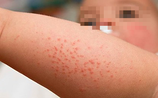 Hai bệnh nhi nguy kịch vì sốt xuất huyết, bác sĩ đưa ra lời khuyên quan trọng